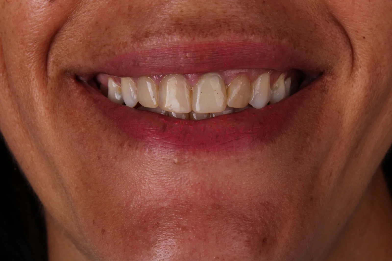 Antes do tratamento com facetas de resina